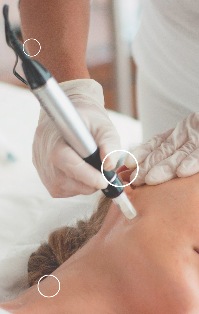 Microneedling